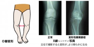 変形性膝関節症　痛み　